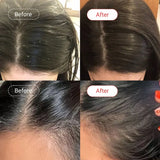 AccuFix Cosmetics Salicylic Acid Shampoo | Medicated Dandruff Shampoo