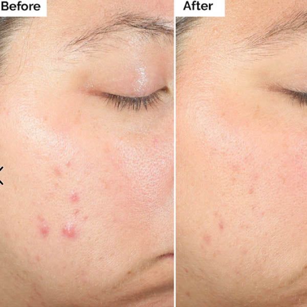The Ordinary Salicylic Acid 2% Exfoliating Blemish Solution